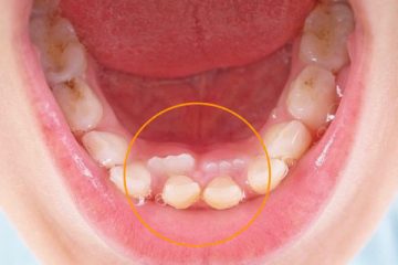 دندان اضافی از علائم سندرم گاردنر