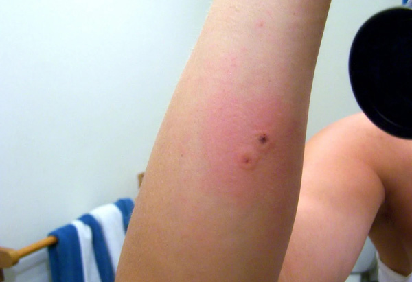 عکس نیش هزارپا