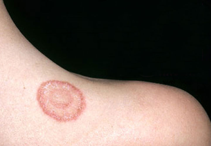 بیماری هایی که از گربه به انسان منتقل می‌شوند - درماتوفیتوز یک بیماری مشترک بین انسان و گربه است که باعث ایجاد ضایعات دایره ای شکل در فرد می شود.